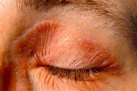 Eyelid Eczema Eyelid Dermatitis Symptoms Causes And Treatment
