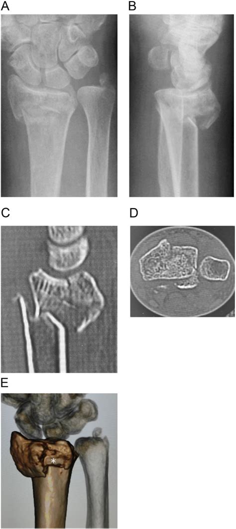 Preoperative Image Showing The Comminuted Intra Articular Distal Radial