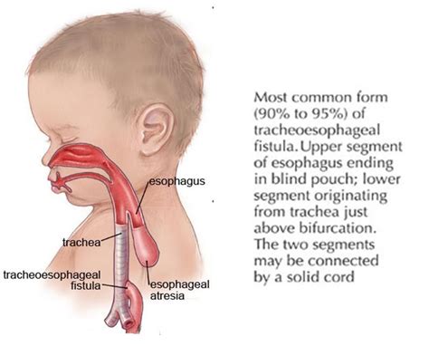 Tracheoesophageal Fistula Pediatrics Nclex Esophageal Atresia