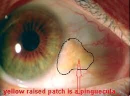 Yellow eyes can be alcohol induced, but it could be caused due to other reasons as well. What is the cause of a small yellow spot on the sclera of ...