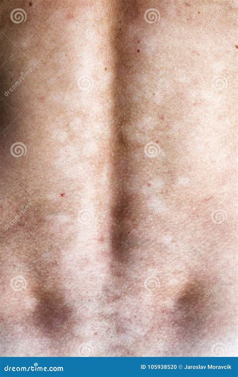 Fungal Infection Of The Skin Stock Photo Image Of Back Skin 105938520