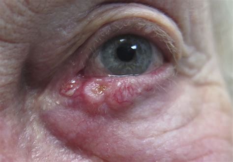 Eyelid Cancers Malignancies Saul Rajak Ophthalmology