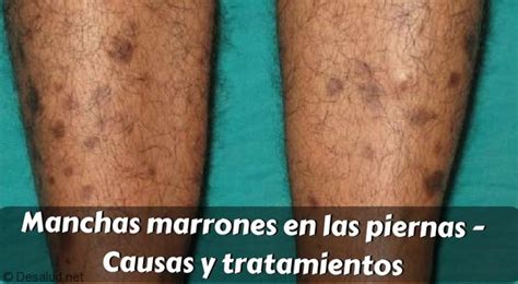 Que Causa Las Manchas Marrones En Las Piernas Temas De Belleza