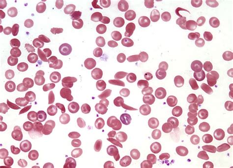 Sickle Cell Anemia At 40x Magnification Microscopyu