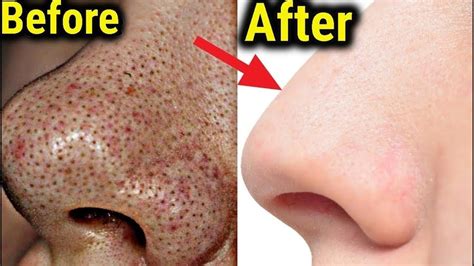 Quick Remedy For Blackheads On Nose Youtube