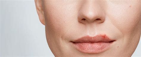 The cold sore isn't healing, is spreading or you have more than 1 cold sore. What Triggers Your Cold Sores? | Abreva