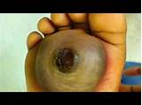 Photos of How Do Doctors Test For Genital Warts