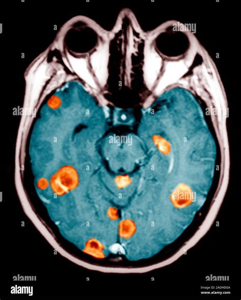 Brain Cancer Coloured Axial Horizontal Magnetic Resonance Imaging