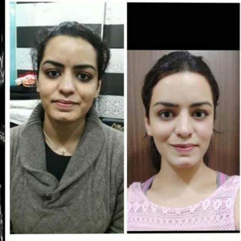 Facial Hyperpigmentation And Uneven Skin Tone By Dr Niharika Chugh
