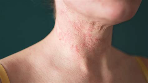 Eczema On The Face And Neck Triggers And Treatment Everyday Health