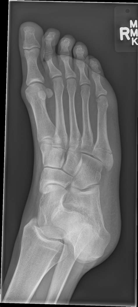 Primary fracture healing and secondary fracture healing are two different types of healing in a substantial amount of energy is needed for fracture healing to occur. Jones Fracture - XRay Posted! Please help....