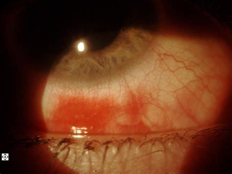 Hemorrhagic Viral Conjunctivitis Sonoran Desert Eye Center