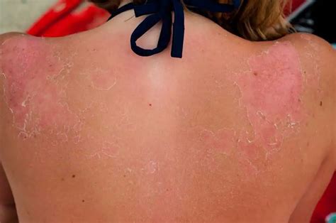 Skin Cancer Types Images Symptoms Rash Spots Bumps And Skin Cancer