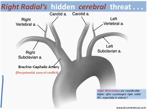 A cerebral angiography is recommended, when the patient has complaints about memory loss, slurred speech, headaches, blurred vision, or a loss of. right mca stroke in right radial angiogram | Dr.S ...