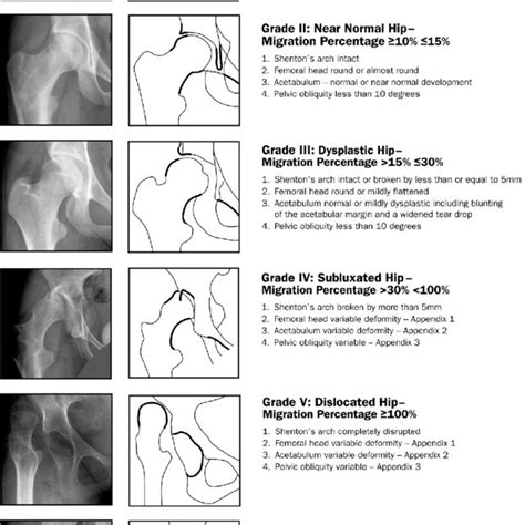 Radiographs And Diagrams Showing The Hip Classification System In