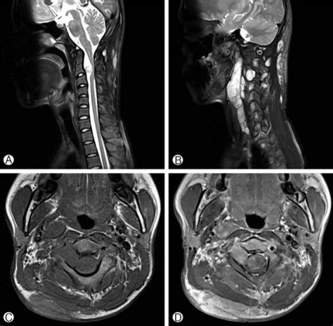 Preoperative Mri Of Cervical Spine T1 A And T2 Weighted B Sagittal
