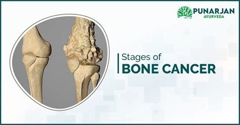 Stages Of Bone Cancer Treatment Of Bone Cancer