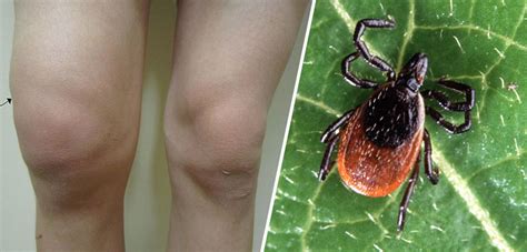 Is It Infectious Arthritis Or Lyme Disease Orthopedics This Week