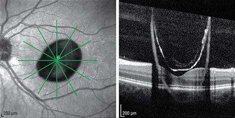 Imaging Of A Pigmented Free Floating Vitreous Cyst Jama Ophthalmology