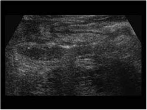 Abdomen And Retroperitoneum 15 Appendix Case 153 Complicated