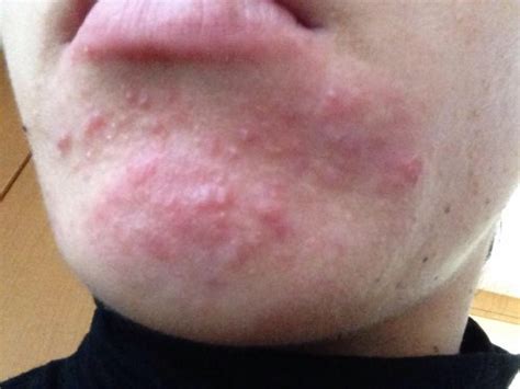 アゴのブツブツ ※画像あり -あごのぶつぶつ、赤み、浸出液が ...