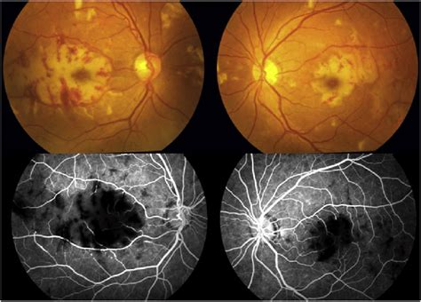 Fundus Picture Fundus Fluorescein Angiography Images Of Both Eyes At