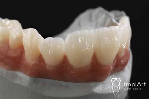 Tipos De Coroas Dentárias Conheça Os 5 Principais Modelos