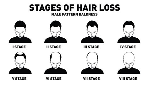 7 Stages Of Male Pattern Baldness And Homeopathy Treatment Dr Batras