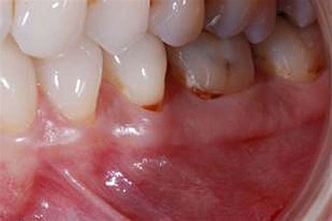 Root Caries On The Buccal Aspects Of The Mandibular Left Second