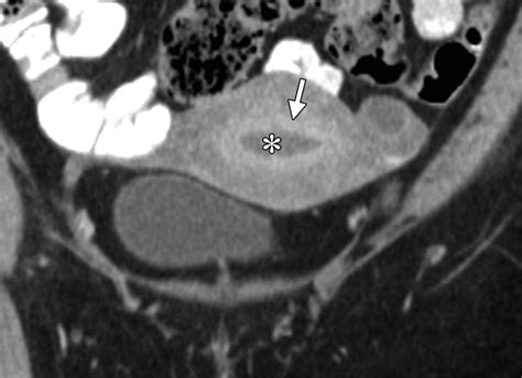 normal or abnormal demystifying uterine and cervical contrast enhancement at multidetector ct