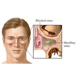 To grow, growth, growing, a grown; Sinus Infection And Toothache