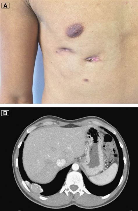 Tuberculosis Abscess Of The Chest Wall In The American Journal Of