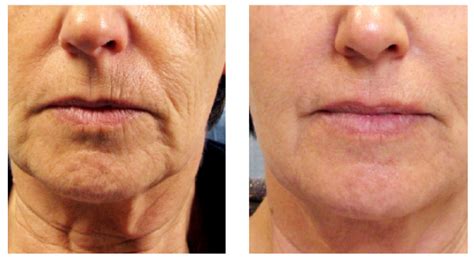 Tixel Before And After 3 Tribeca Skin Center