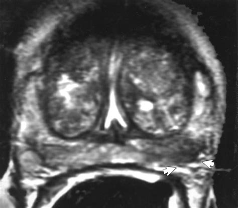Endorectal Color Doppler Sonography And Endorectal MR Imaging Features Of Nonpalpable Prostate