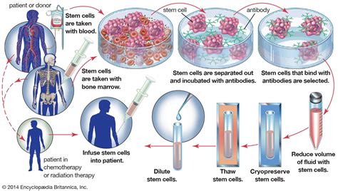 Bone Marrow Transplant Stem Cell