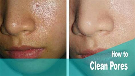 Clearing Out Clogged Pores Clear Clogged Pores Blocked Pores Clean