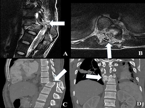 Spinal Cord Injury Ct Scan Ct Scan Machine