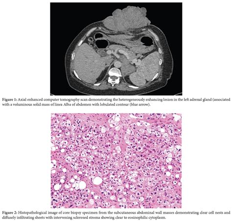 Cutaneous Metastasis Revealing Adrenocortical Carcinoma A Case Report