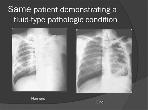 Ppt More Cxr Powerpoint Presentation Free Download Id6642592