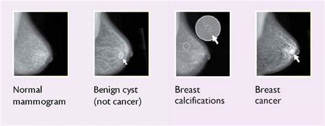 Is A Lump In Your Breast Always Cancer 4 Signs Of Breast Cancer