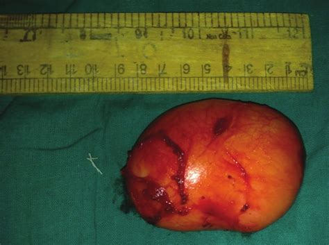 Giant Sublingual Epidermoid Cyst Resembling Plunging Ranula Verma S