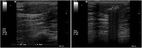 Ultrasound Images Of An Untreated And A Treated Lipoma A An Oval