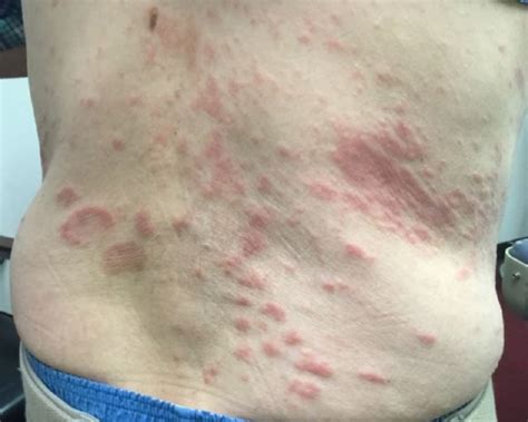 Derm Dx Multiple Itchy Plaques On The Trunk And Extremities