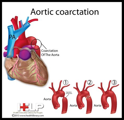 11 Best Coarctation Of The Aorta Images On Pinterest Chd Awareness Coarctation Of The Aorta