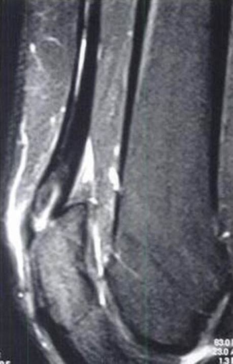 Quadriceps Tendonitis Knee Sports Orthobullets