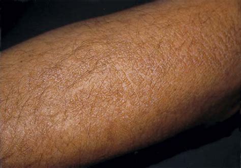 Unilateral Colloid Milium Of The Arm Journal Of The American Academy