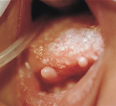 Several hamartomata have characteristic imaging. Retinal Hamartoma in Oral-Facial-Digital Syndrome ...