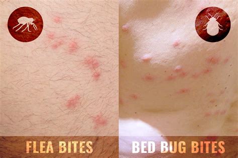 Difference Between Bed Bug Bites And Flea Bites On Humans Bed Western