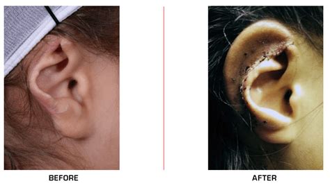Otoplasty Best Surgeon Ear Surgery Nyc Ear Reconstruction Gallery