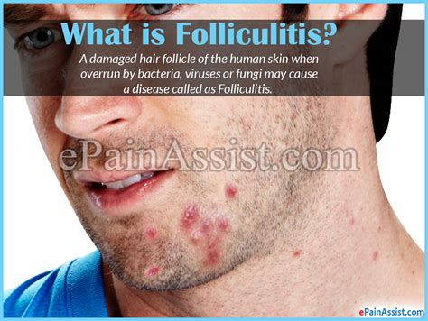 Folliculitis On Chin